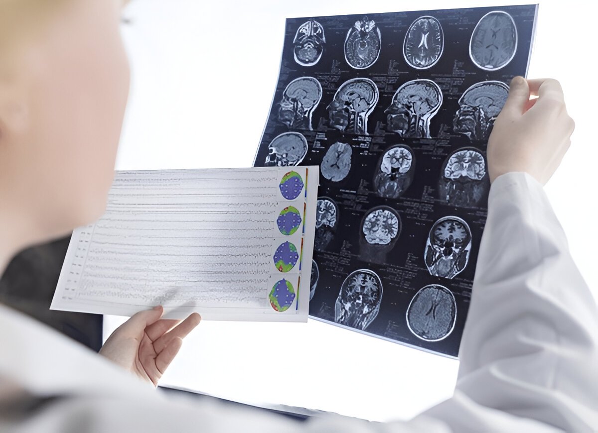 Что такое эпилепсия и как она проявляется у разных людей?