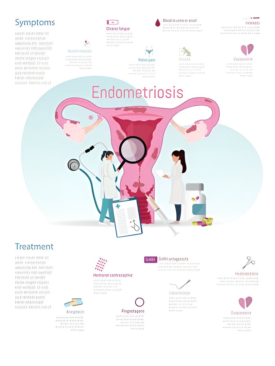 Что такое эндометриоз и как он влияет на здоровье и качество жизни женщины?