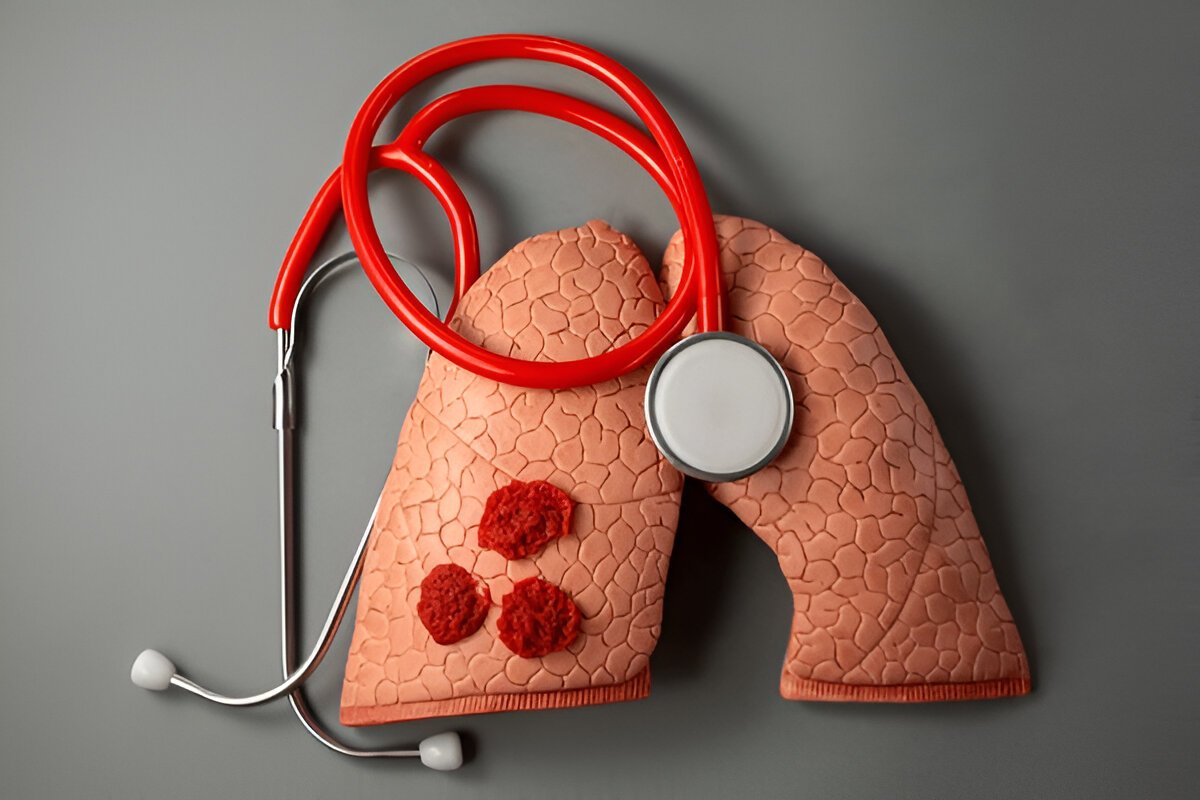 Что такое туберкулез и какие меры предосторожности помогают его избежать?