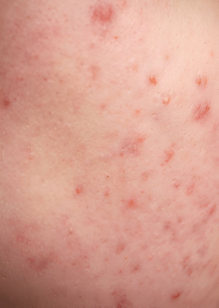 Что делать, если вы обнаружили прыщ на половой губе как шарик