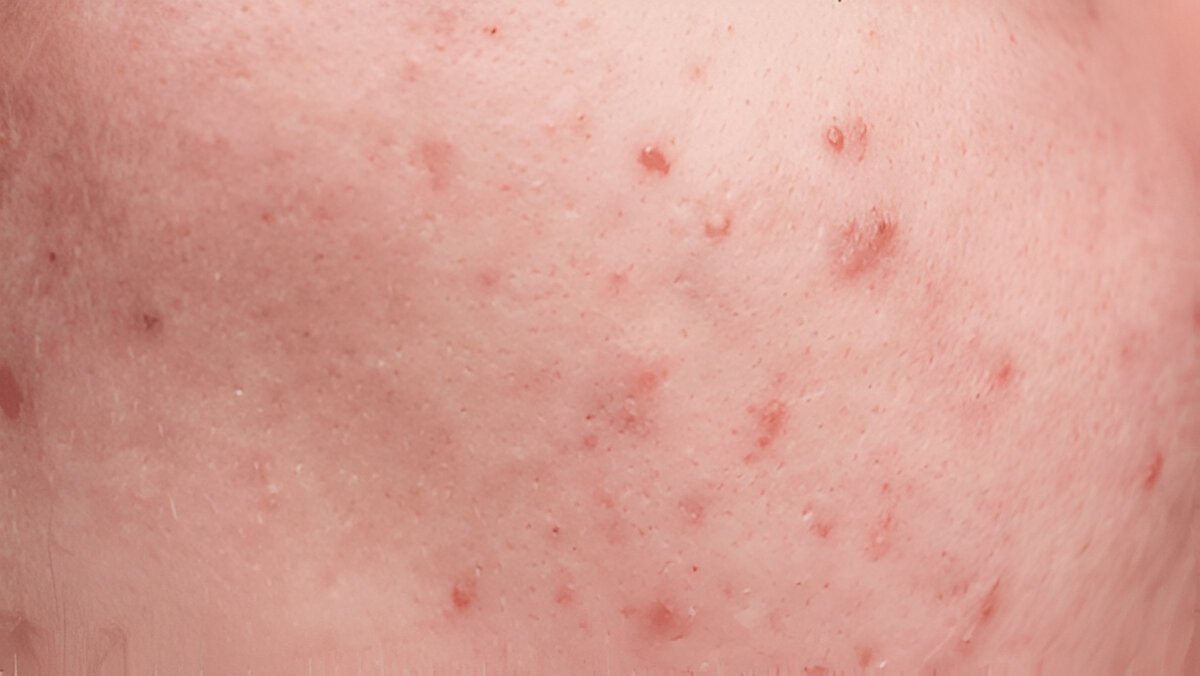 Что делать, если вы обнаружили прыщ на половой губе как шарик