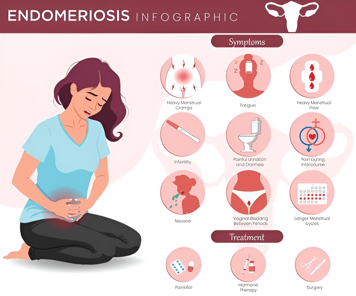 Что такое эндометриоз и как он влияет на здоровье и качество жизни женщины?