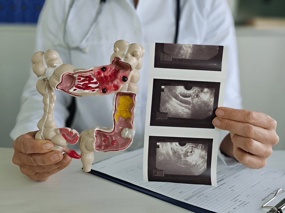 Что такое колоноскопия и как проходит эта процедура диагностики кишечника?