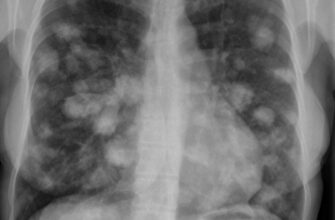 Що таке вузли в легенях: причини, діагностика та лікування