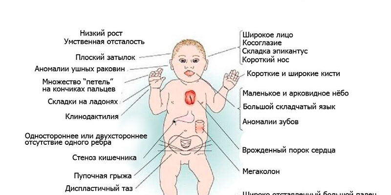 Що таке синдром Дауна: визначення, причини та особливості розвитку Що таке синдром Дауна: визначення, причини та особливості розвитку